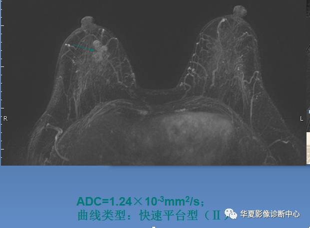 【PPT】乳腺导管原位癌的MRI诊断