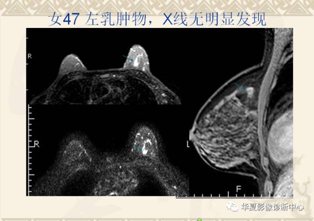 【PPT】乳腺导管原位癌的MRI诊断