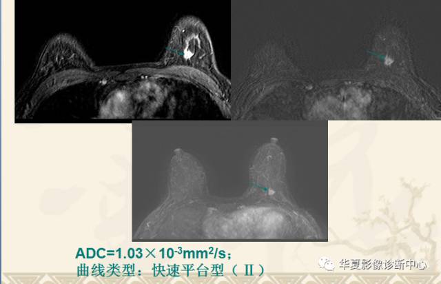 【PPT】乳腺导管原位癌的MRI诊断