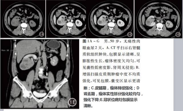 【PPT】CT对于不同病理亚型肾细胞癌诊断