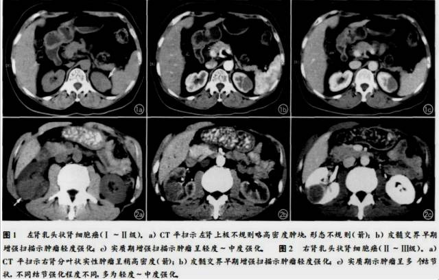 【PPT】CT对于不同病理亚型肾细胞癌诊断