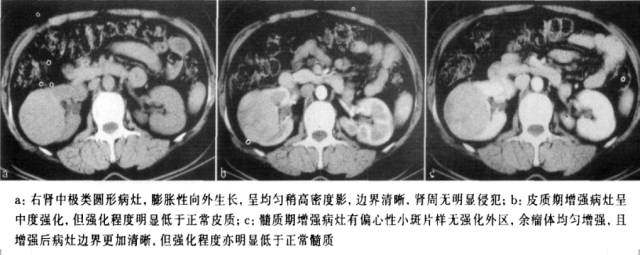 【PPT】CT对于不同病理亚型肾细胞癌诊断