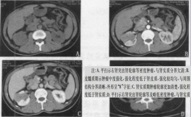 【PPT】CT对于不同病理亚型肾细胞癌诊断