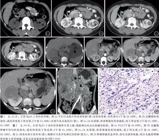 【PPT】CT对于不同病理亚型肾细胞癌诊断
