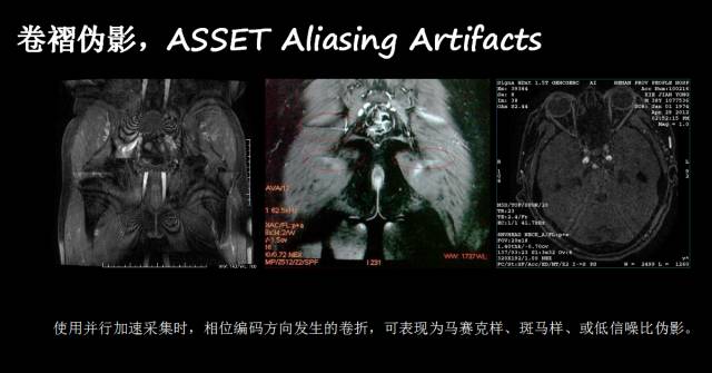 【PPT】磁共振常见伪影及对策