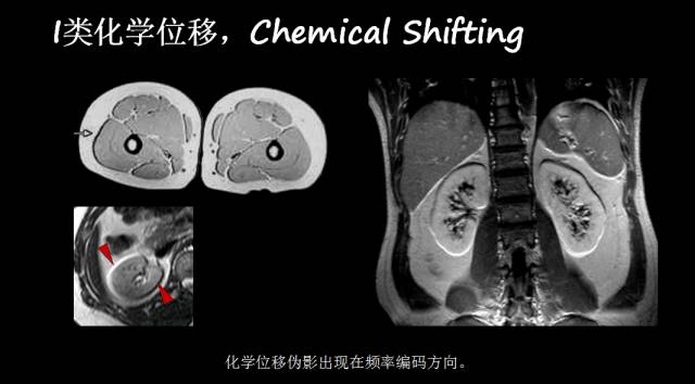 【PPT】磁共振常见伪影及对策