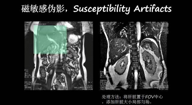 【PPT】磁共振常见伪影及对策