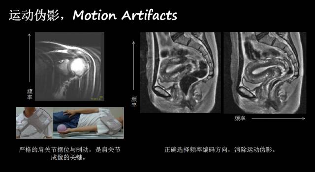 【PPT】磁共振常见伪影及对策