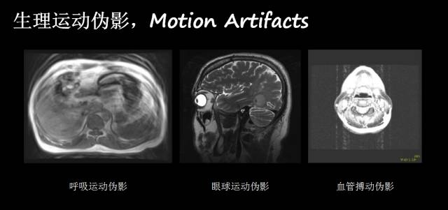 【PPT】磁共振常见伪影及对策