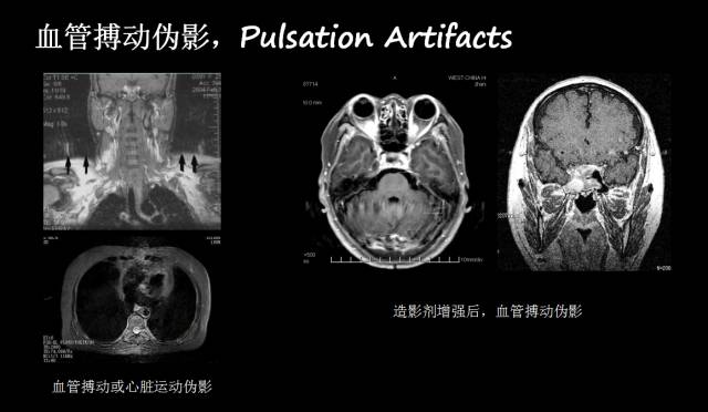 【PPT】磁共振常见伪影及对策