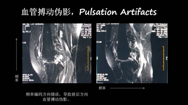【PPT】磁共振常见伪影及对策