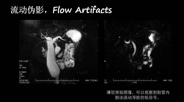 【PPT】磁共振常见伪影及对策