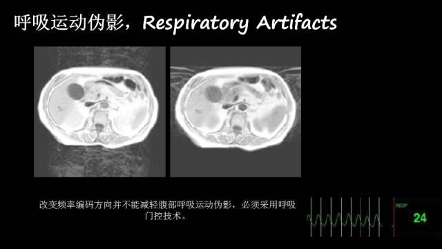 【PPT】磁共振常见伪影及对策