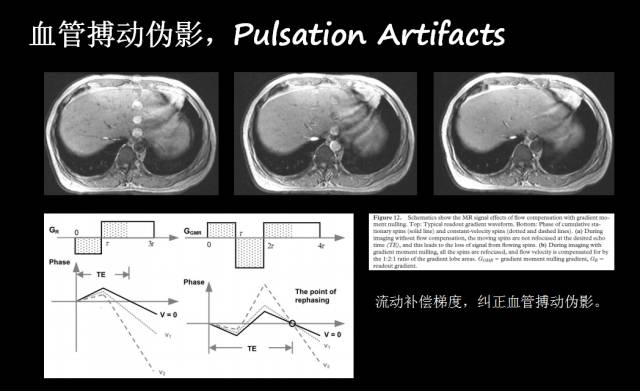 【PPT】磁共振常见伪影及对策