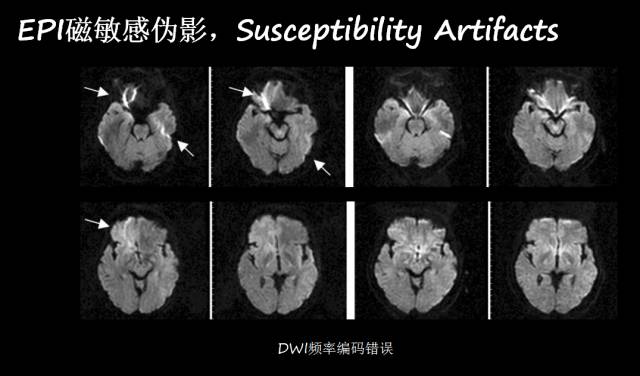 【PPT】磁共振常见伪影及对策