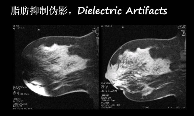 【PPT】磁共振常见伪影及对策