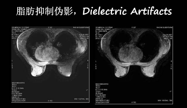 【PPT】磁共振常见伪影及对策