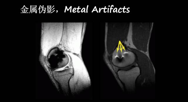 【PPT】磁共振常见伪影及对策