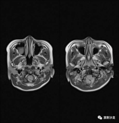 【病例】Chiari畸形1例MR影像表现 【病例】Chiari畸形1例MR影像表现