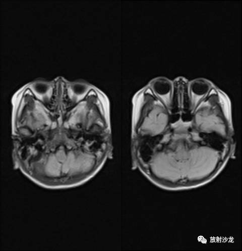 【病例】Chiari畸形1例MR影像表现 【病例】Chiari畸形1例MR影像表现