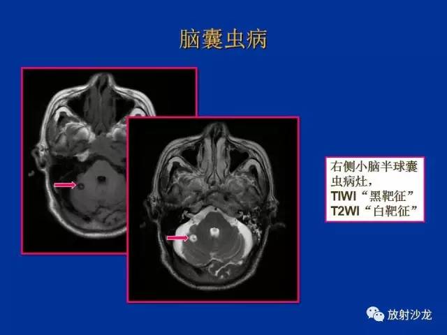 【PPT】脑囊虫病
