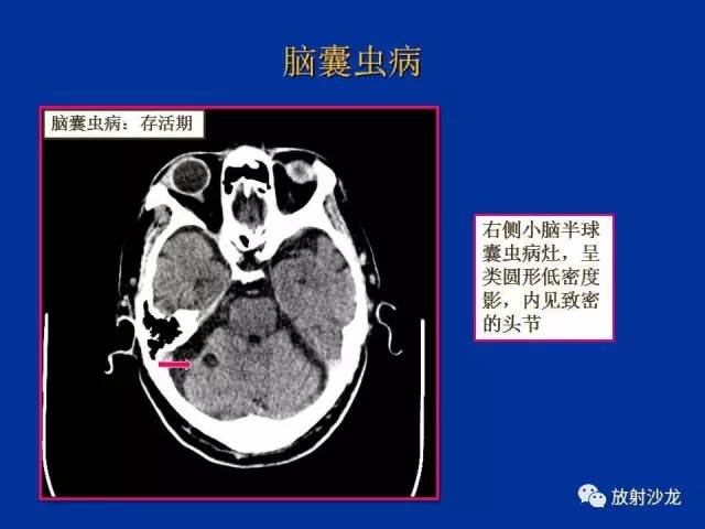 【PPT】脑囊虫病