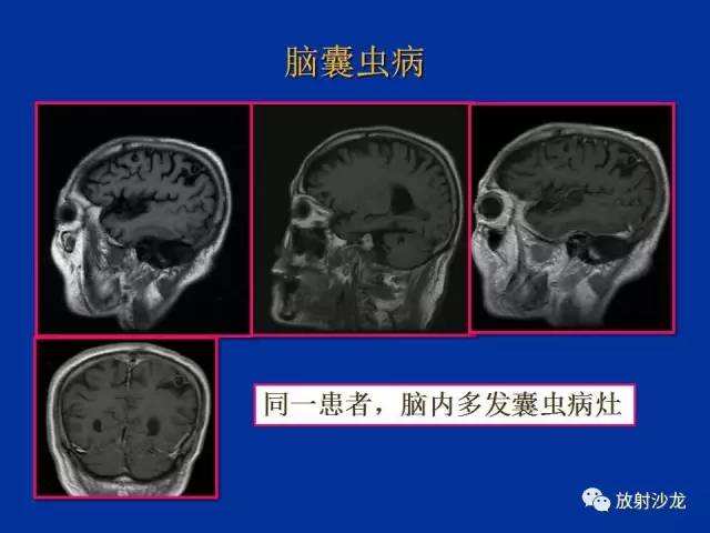 【PPT】脑囊虫病
