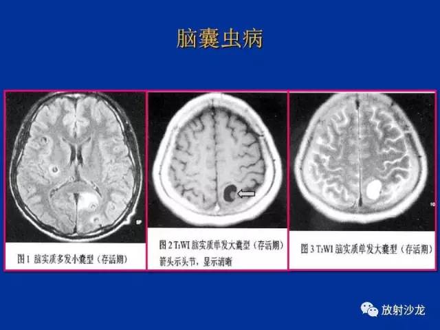 【PPT】脑囊虫病