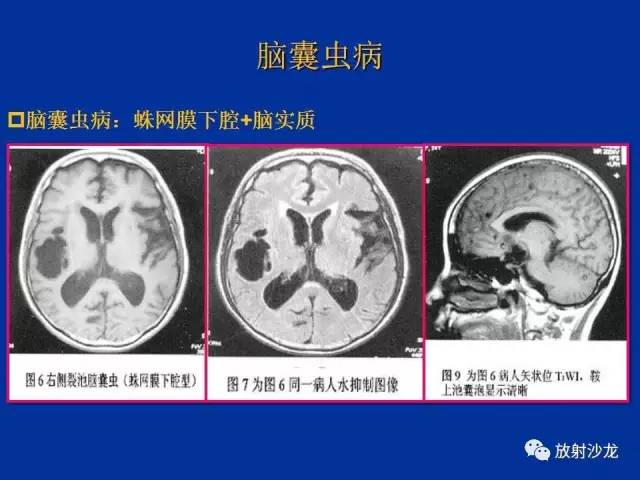 【PPT】脑囊虫病