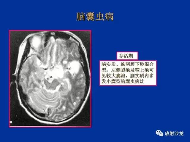【PPT】脑囊虫病