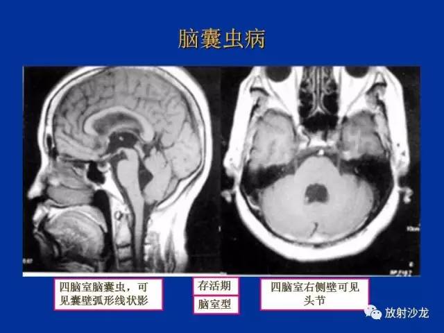 【PPT】脑囊虫病