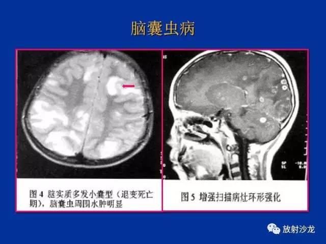 【PPT】脑囊虫病