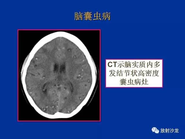 【PPT】脑囊虫病