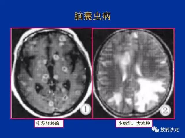 【PPT】脑囊虫病