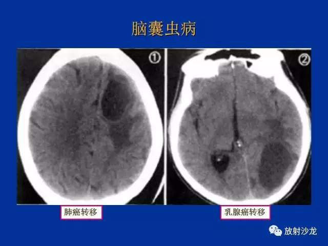 【PPT】脑囊虫病
