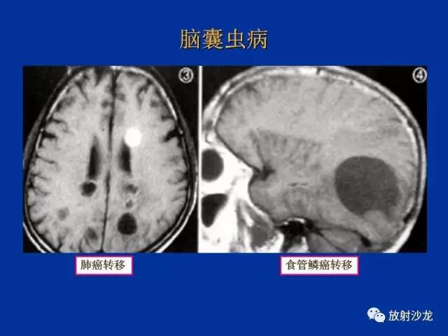 【PPT】脑囊虫病