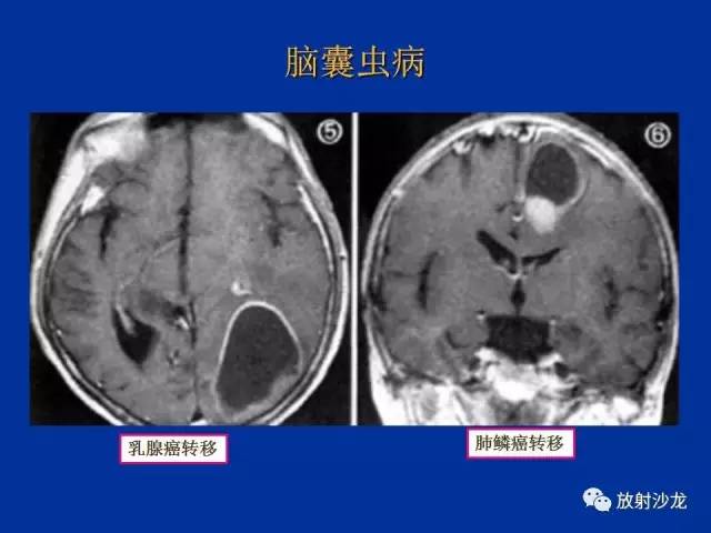 【PPT】脑囊虫病