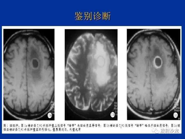 【PPT】脑囊虫病