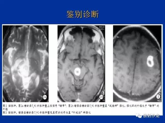 【PPT】脑囊虫病
