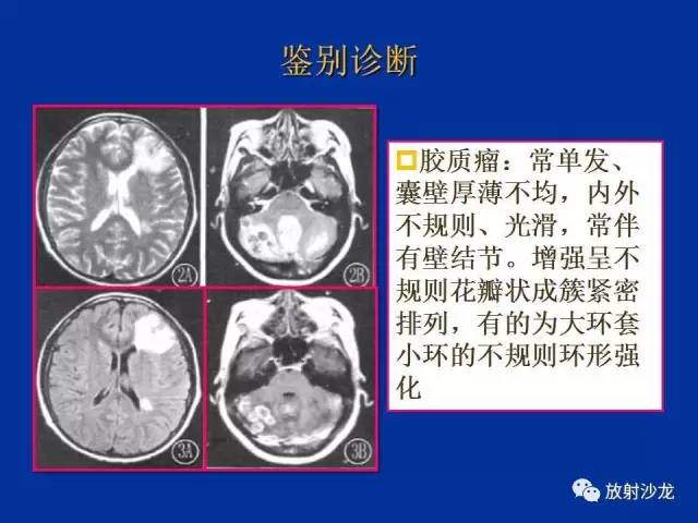 【PPT】脑囊虫病