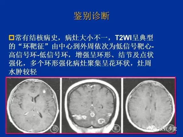 【PPT】脑囊虫病