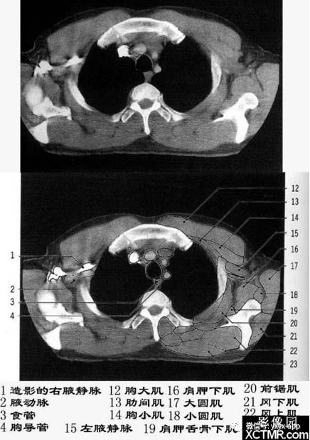 5分钟读懂纵隔(胸部) 5分钟读懂纵隔(胸部)