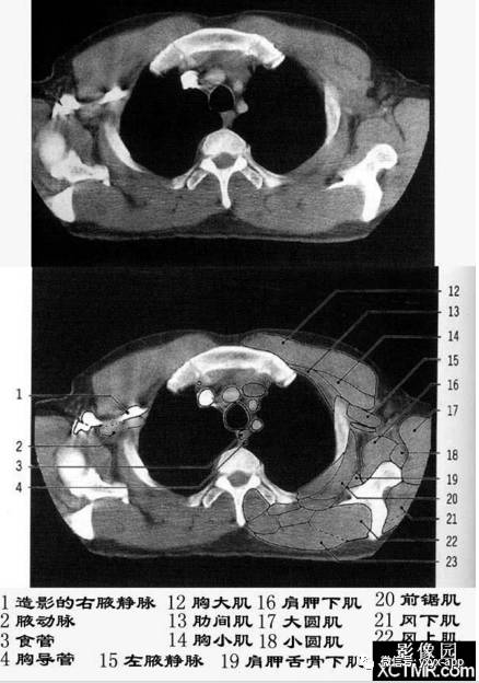 5分钟读懂纵隔(胸部) 5分钟读懂纵隔(胸部)