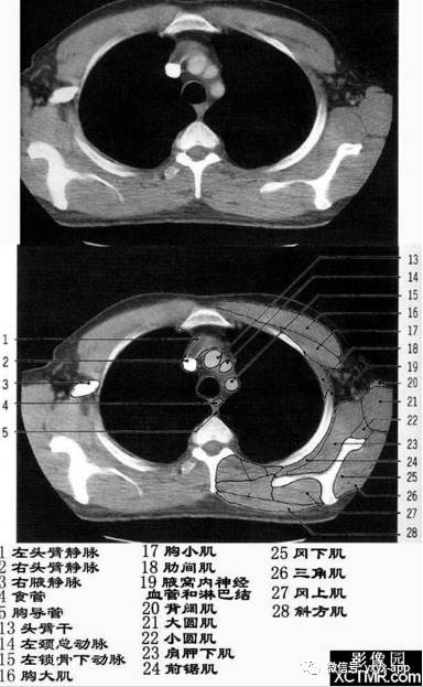 5分钟读懂纵隔(胸部) 5分钟读懂纵隔(胸部)