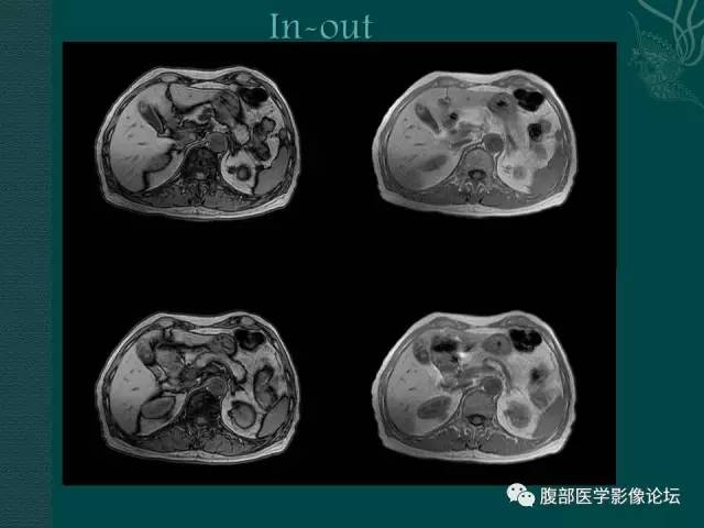 【病例】胆囊腺瘤1例MR影像表现 【病例】胆囊腺瘤1例MR影像表现