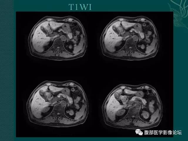 【病例】胆囊腺瘤1例MR影像表现 【病例】胆囊腺瘤1例MR影像表现