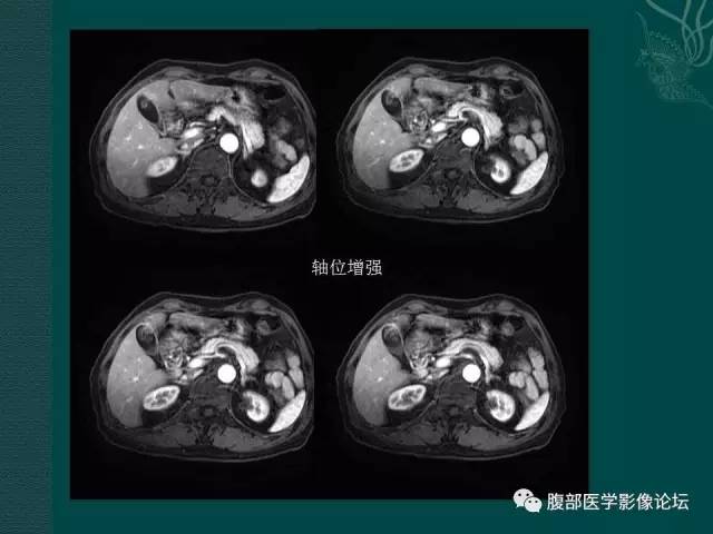 【病例】胆囊腺瘤1例MR影像表现 【病例】胆囊腺瘤1例MR影像表现