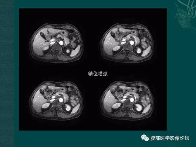 【病例】胆囊腺瘤1例MR影像表现 【病例】胆囊腺瘤1例MR影像表现