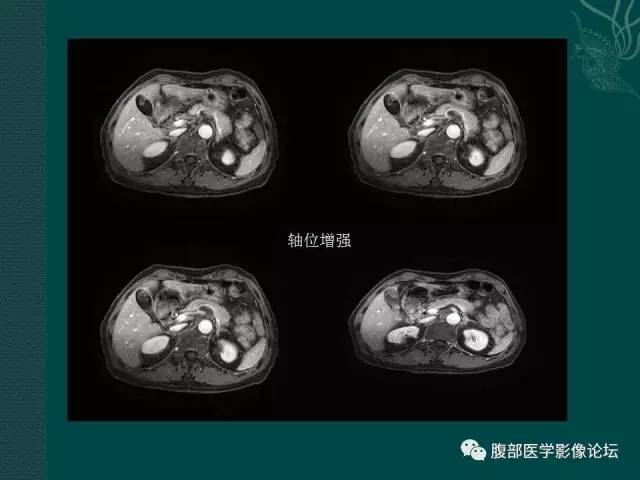 【病例】胆囊腺瘤1例MR影像表现 【病例】胆囊腺瘤1例MR影像表现
