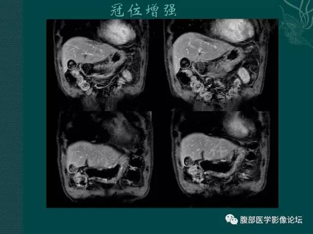【病例】胆囊腺瘤1例MR影像表现 【病例】胆囊腺瘤1例MR影像表现